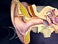 Cochlear Implants