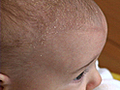 Tips to Treat and Prevent Cradle Cap