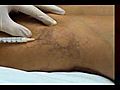 Foam sclerotherapy to remove leg veins. www.drzachary.net