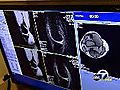 MRI detects knee injuries sooner