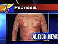 VIDEO: New treatment for Psoriasis