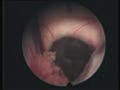 Endoscopic Brain Surgery