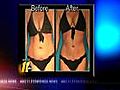 Hi-def laser body sculpting