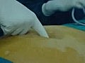 Umblical hernia Surgery Laparoscopic
