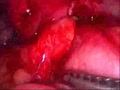 Large Bowel Epiploica Laparoscopic Resection