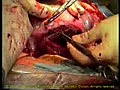 Suturing of Uterus