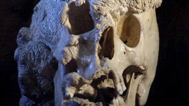 Curse of the Elephant Man: Skull MRI