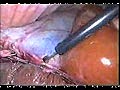 Laparoscopic Cholecystectomy Procedure