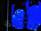 MRI Guided Liver Cancer Treatment