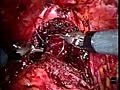 Robotic anastomosis of bladder to urethra