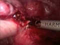 Total Hysterectomy Laparoscopic HD