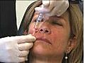 New facial filler comes from own body