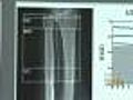 2 Million Men Have Osteoporosis