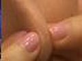 Message To Teens: Popping Zits Can Make Acne Worse