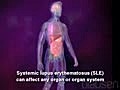 Systemic Lupus Erythematosus Animation