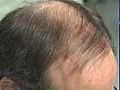 Link between baldness and cancer