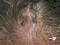 [Video] Hair transplants for women