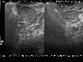 Transvaginal Ultrasound in Ectopic Pregnancy
