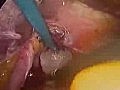 Collis-Nissen Fundoplication