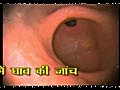 Endoscopy of Esophagus