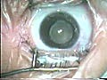 Secondary Cataract