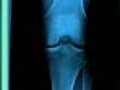 Weightloss Could Help Your Knee Pain