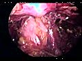 Laparoscopic Radical Prostatectomy