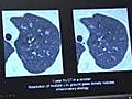 Study: CT screening cuts lung cancer deaths