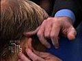 Hair Restoration for Men