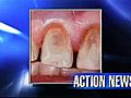 VIDEO: Acid erosion a rising dental problem