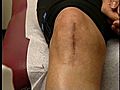 [Video] Growing new knees right in the lab