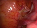 Laparoscopic Supracervical Hysterectomy