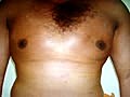 GYNECOMASTIA  IN QATAR