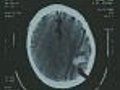 MRIs Could Detect Alzheimers