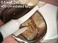 Diode Laser Troughing Examples