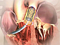 New heart valve animation