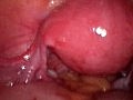 Weibliche Sterilzation Mit Fallopischen Ringe