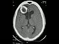 Calcified Brain Abscess