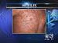 Measles Reported In Traveler From Montgomery Co.