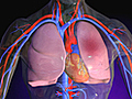 What Is a Pulmonary Embolism?