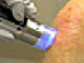 Psoriasis Laser