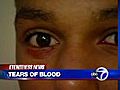 VIDEO: Boy who cries blood