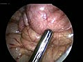 Intussuseption and Appendectomy