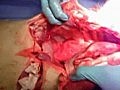 Esophageal En Bloc Mukosektomie