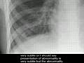 Pneumonia,  on chest x-ray.