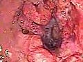 Colonoscopy of a Rectal Cancer With Hemorrhoids