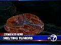 Melting tumors