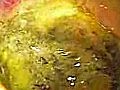 Endosocpy of a Deep Gastric Ulcer