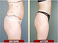 Why are thin,  fit women getting liposuction?