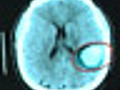 Stroke Blood Clot Ultrasound